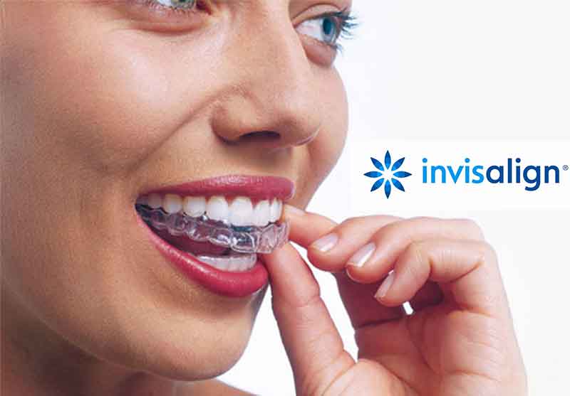 Invisalign vs other brands