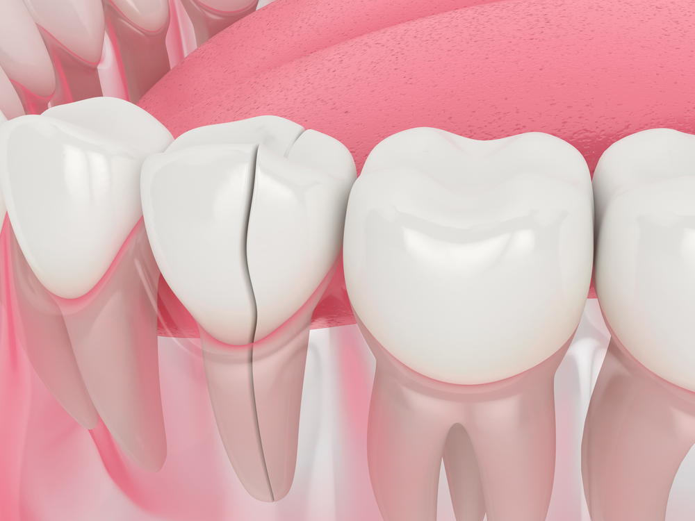 Broken Tooth: What to Do With a Broken Tooth