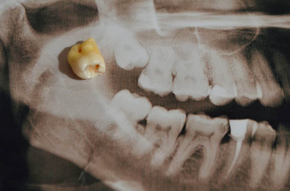 How Long Does It Take For Your Wisdom Teeth To Heal?