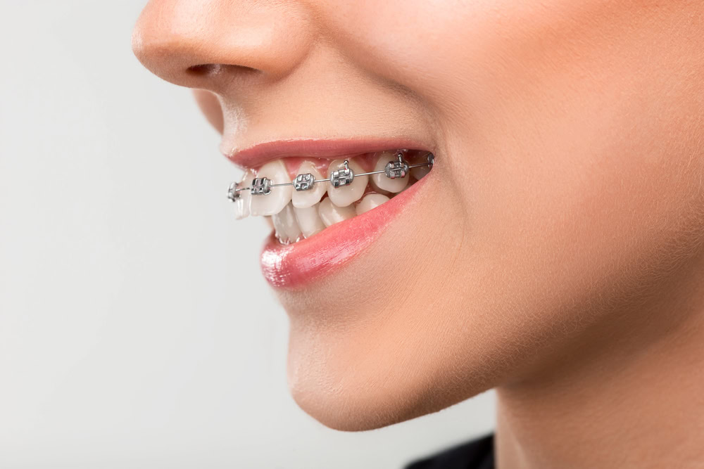 How Long Does the Braces Treatment Take in Wheelers Hill?