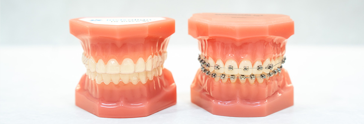 Early Orthodontics In Wheelers Hill And Mount Waverley