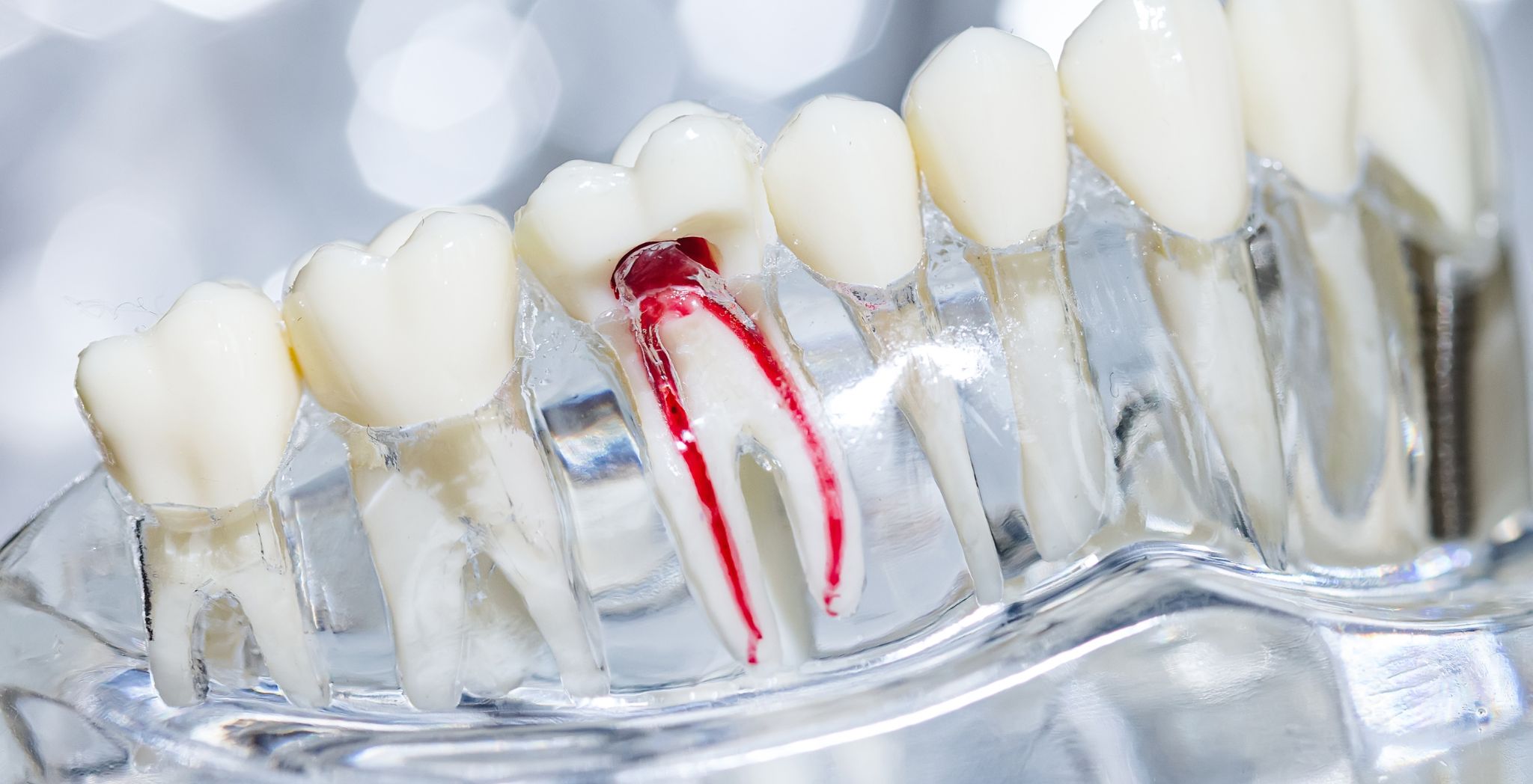 Root Canal Recovery: How Long Does It Take?
