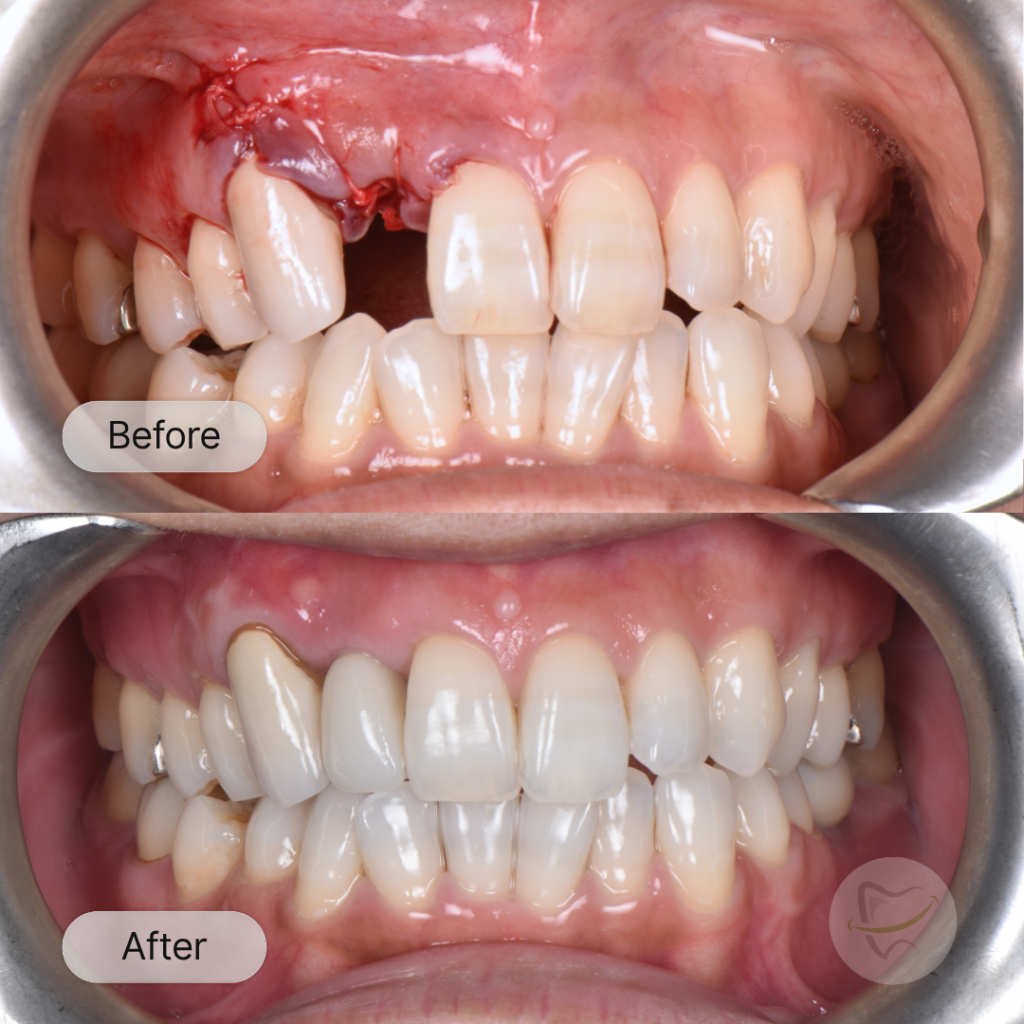 SS Implant In Liberty Dental after 12-15 weeks