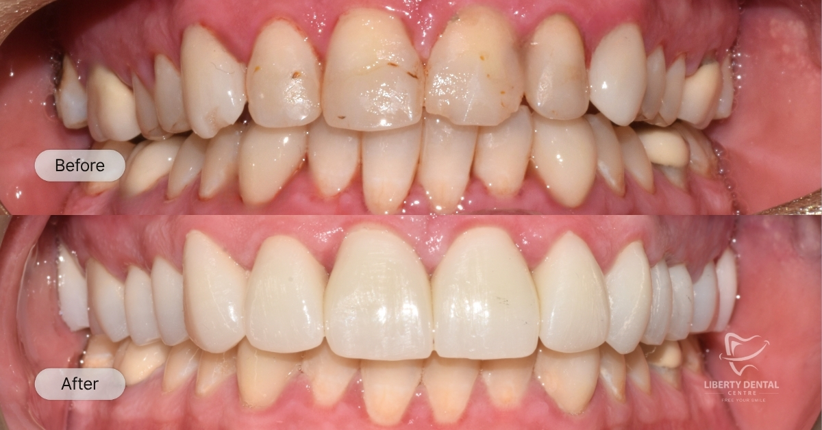 Abbott Of Wantirna South's Veneers And Crowns Smile Makeover 2 weeks