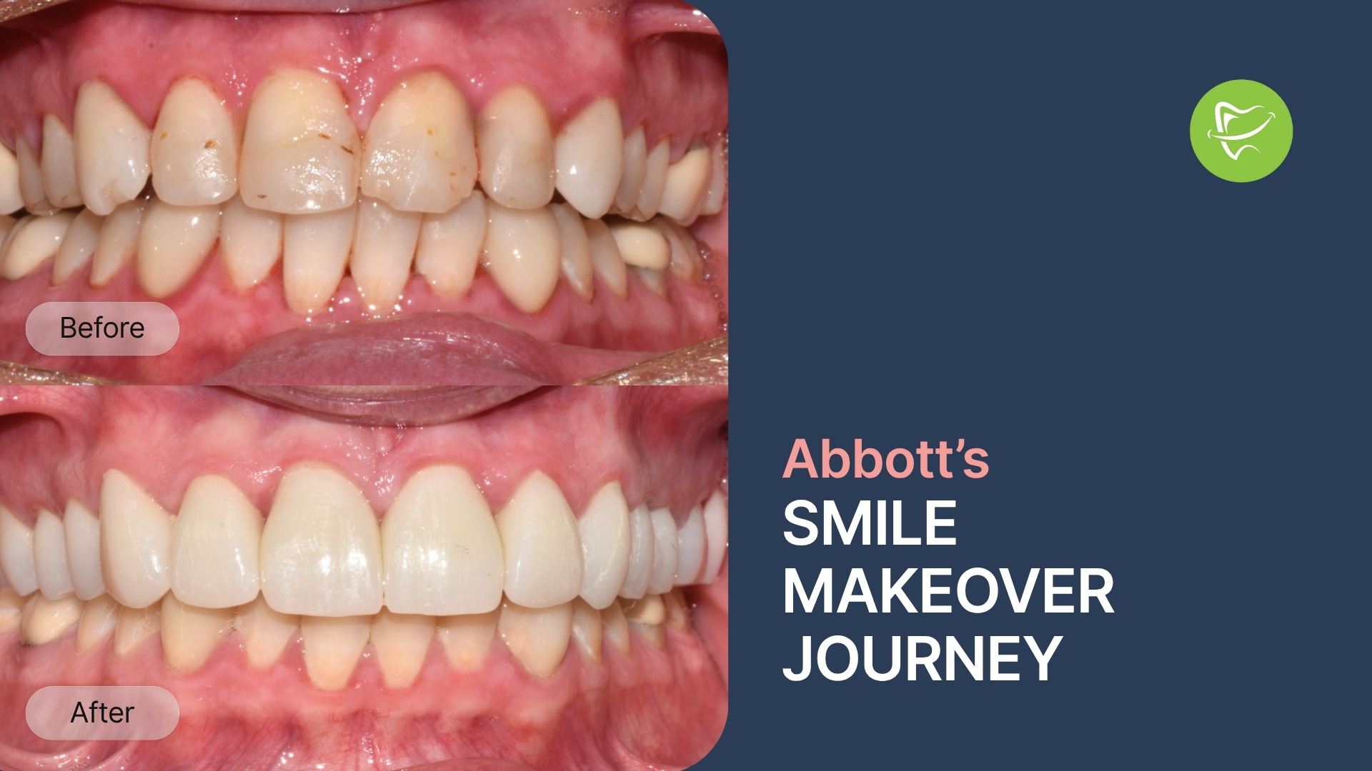 Smile Restoration for Stress Relief: How Abbott from Wantirna South Rebuilt His Smile with Crowns & Veneers at Liberty Dental
