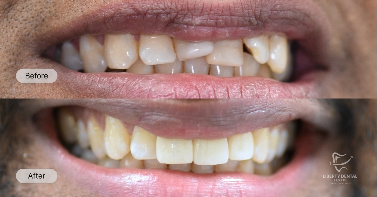 Ajay Of Clayton's Veneers And Crowns Smile Makeover after 2 weeks