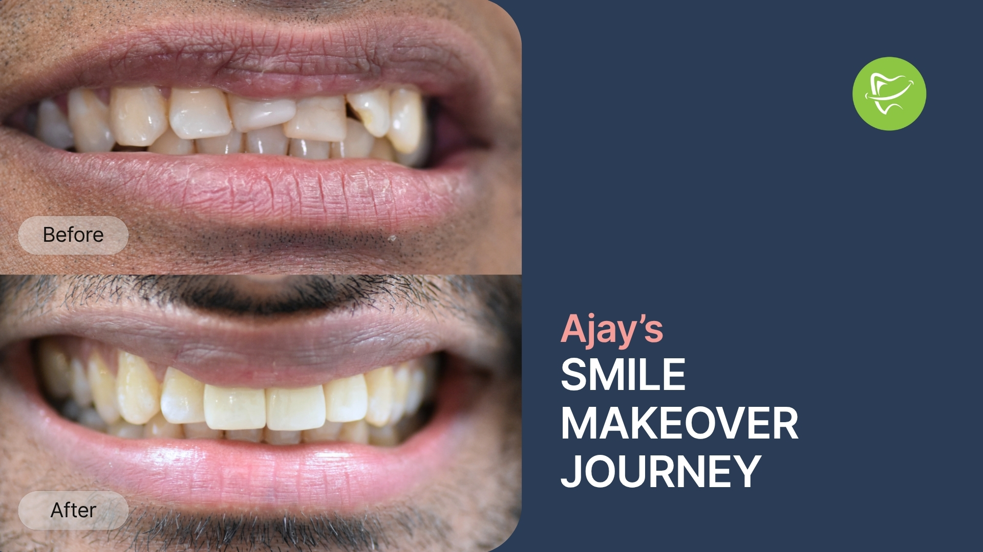 Smile Makeover Before Wedding: How Ajay from Clayton Restored His Smile with Crowns & Veneers at Liberty Dental