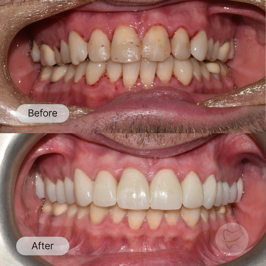 Alan Upper Smile Makeover In Liberty Dental after 12-15 weeks
