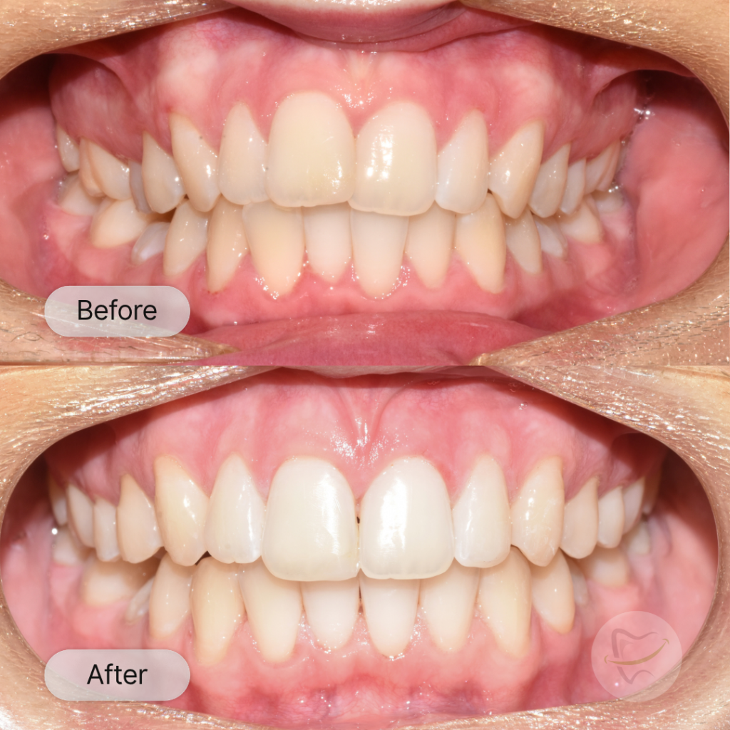 Alex: Invisalign, after 11 months