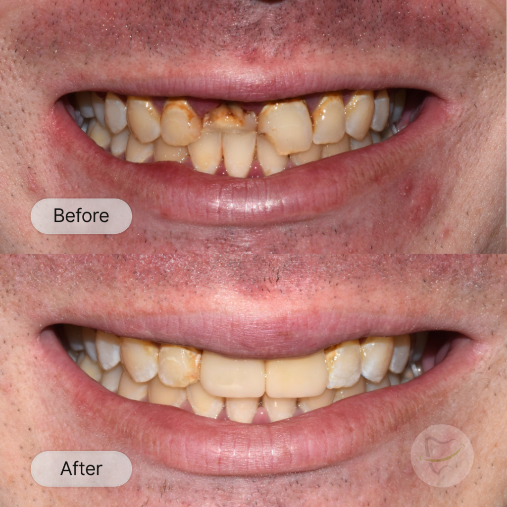 Anthony: Crowns, after 2 weeks