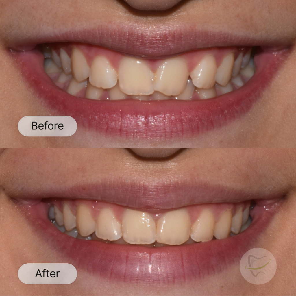 Antonia Braces In Liberty Dental after 8-12 months