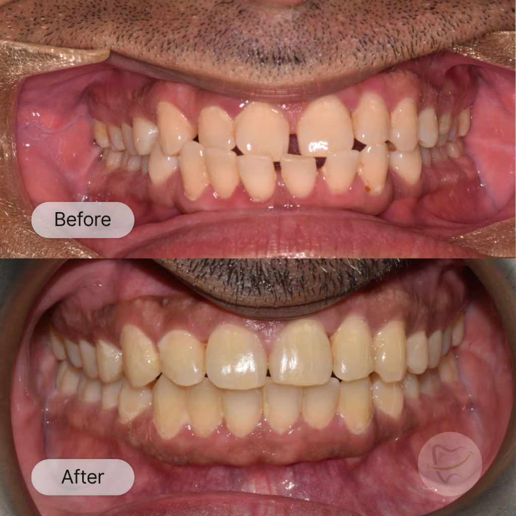AR: Invisalign, after 20 months