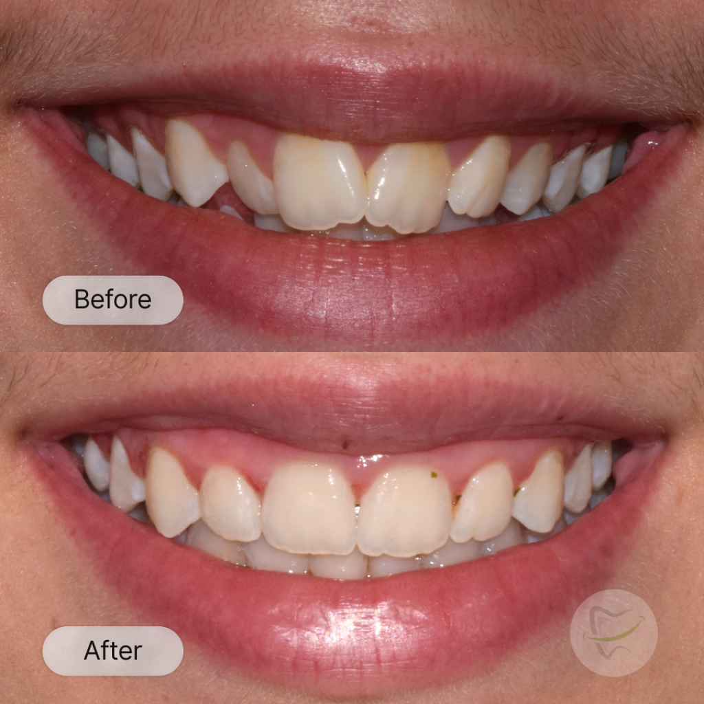 Beks Braces In Liberty Dental after 8-12 months