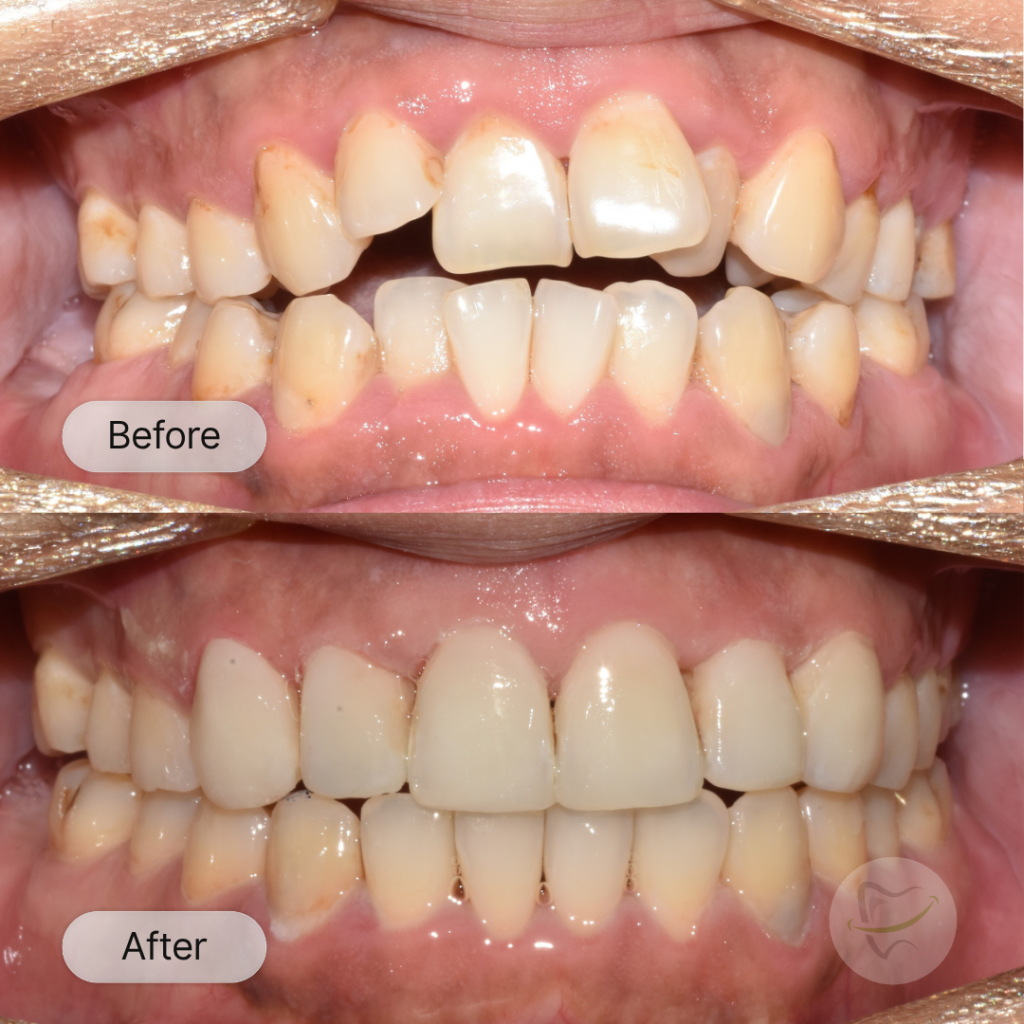 Ben: Invisalign and Veneers, after 15 months