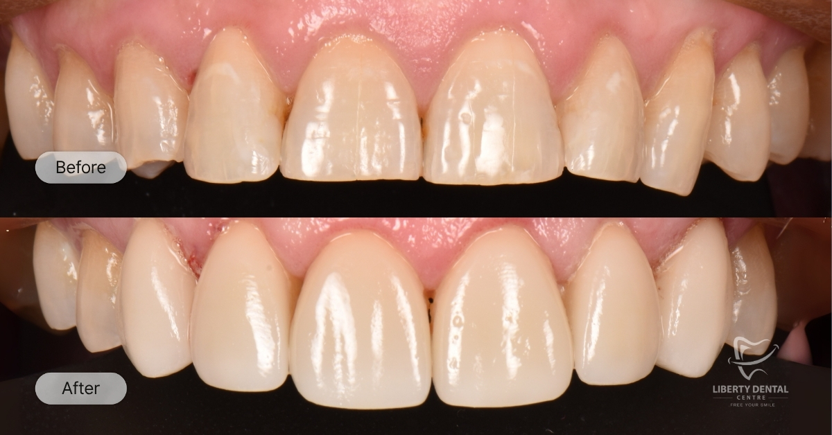 Cara Of Mount Waverley's Porcelain Veneers Smile Makeover