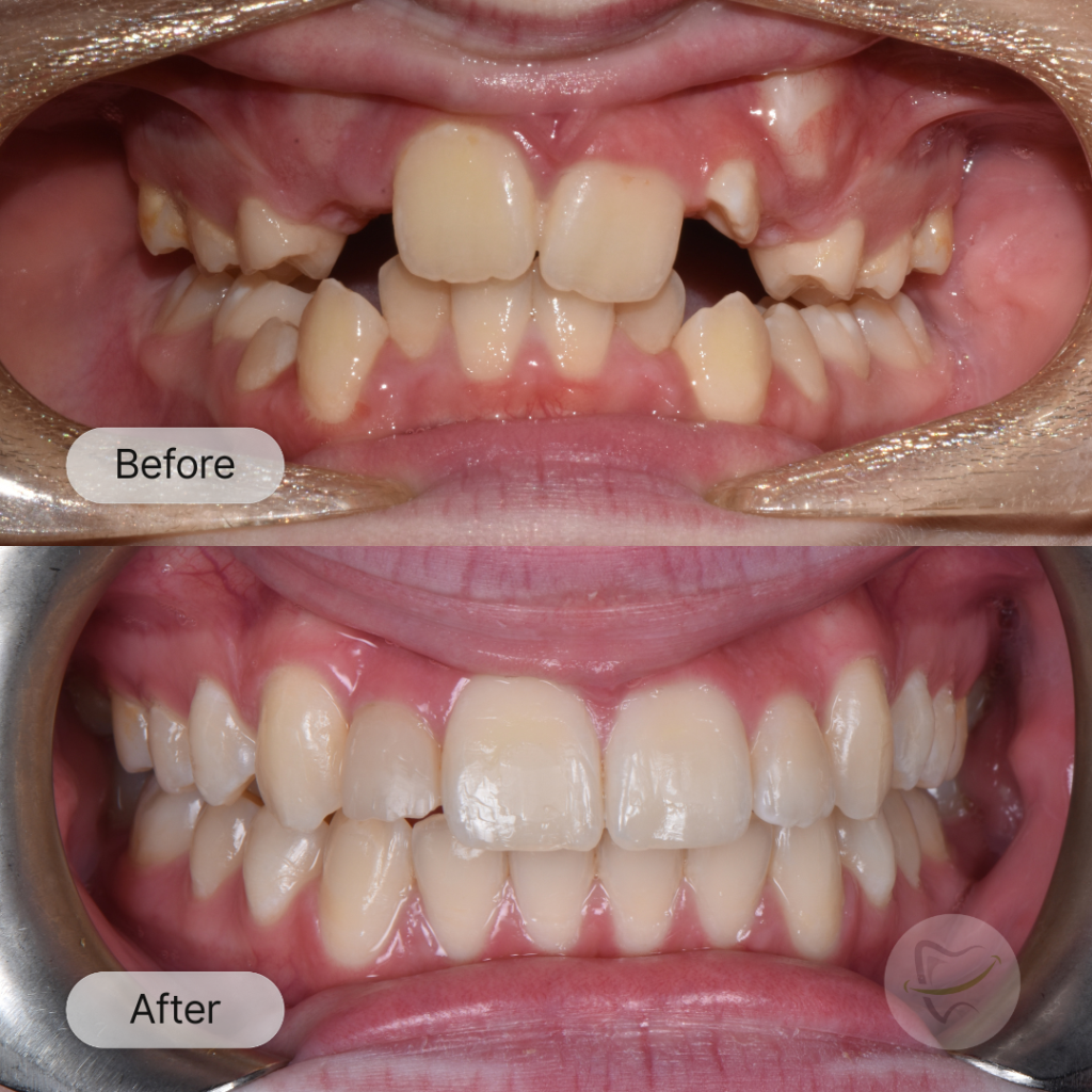Charlotte Braces In Liberty Dental after 8-12 months