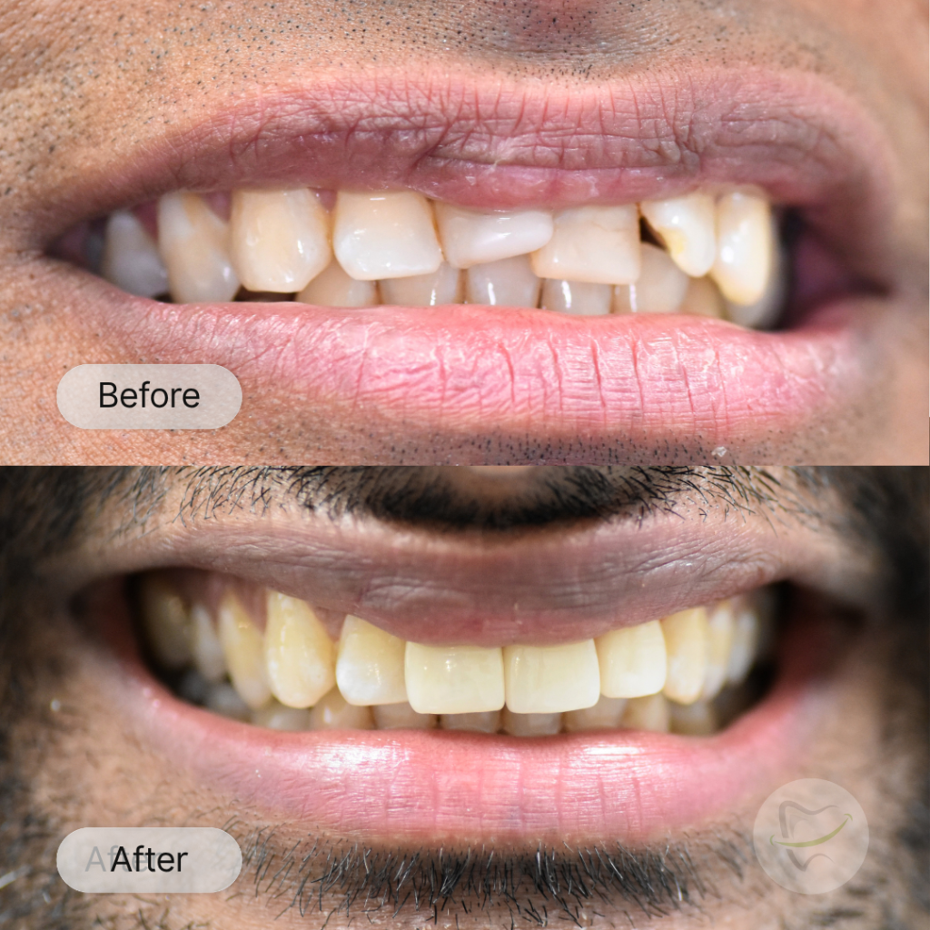 Dasitha: Crowns, after 2 weeks