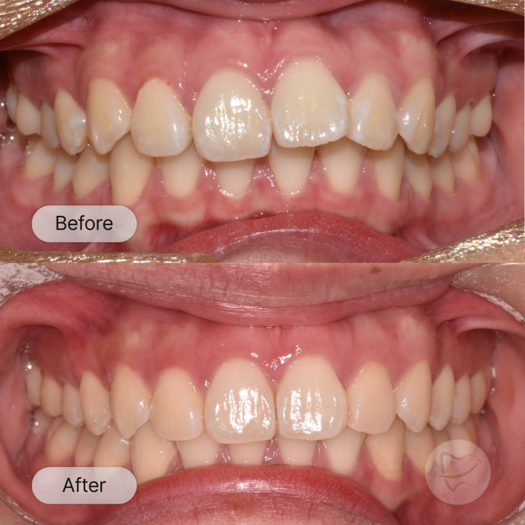 Emily: Invisalign, after 12 months