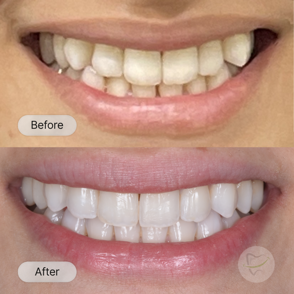 FK: Invisalign and implant, after 24 months