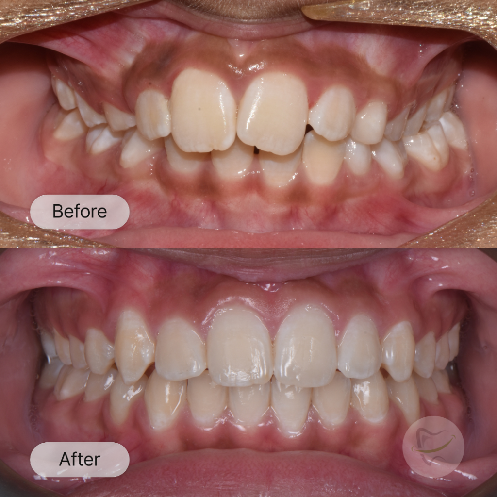 Gauvrav Braces In Liberty Dental after 8-12 months