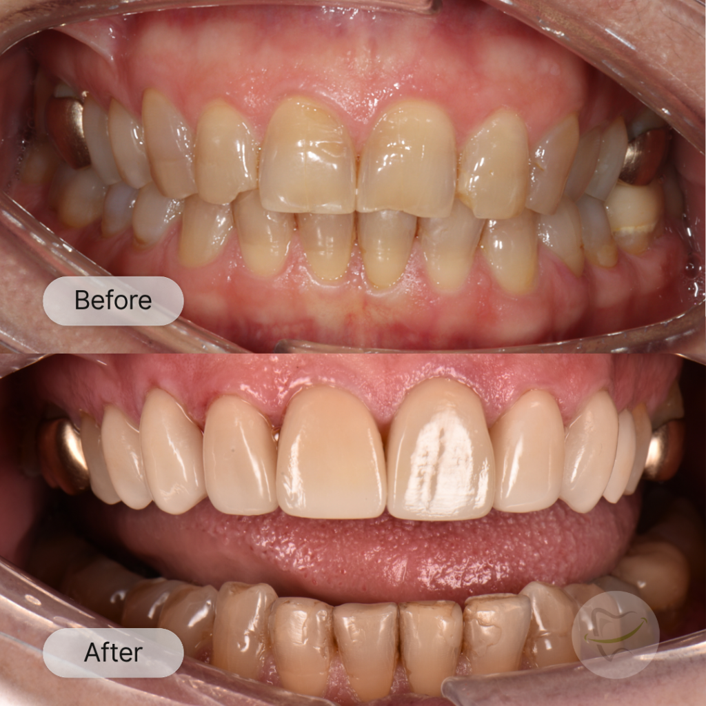 G: Veneers after 2 weeks