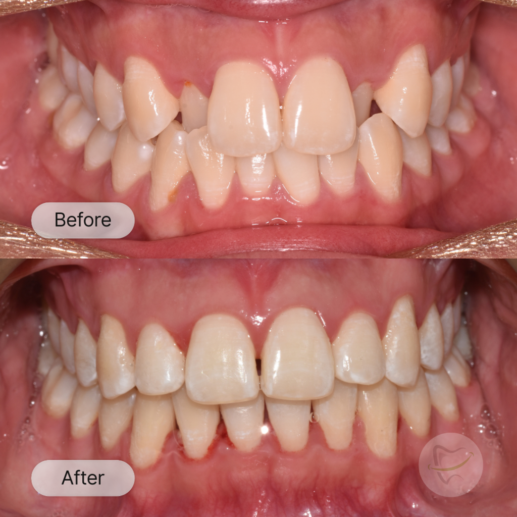 Giselle Braces In Liberty Dental after 8-12 months