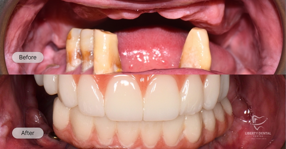 Graham Of Glen Waverley's All On X Smile Makeover after 1 week