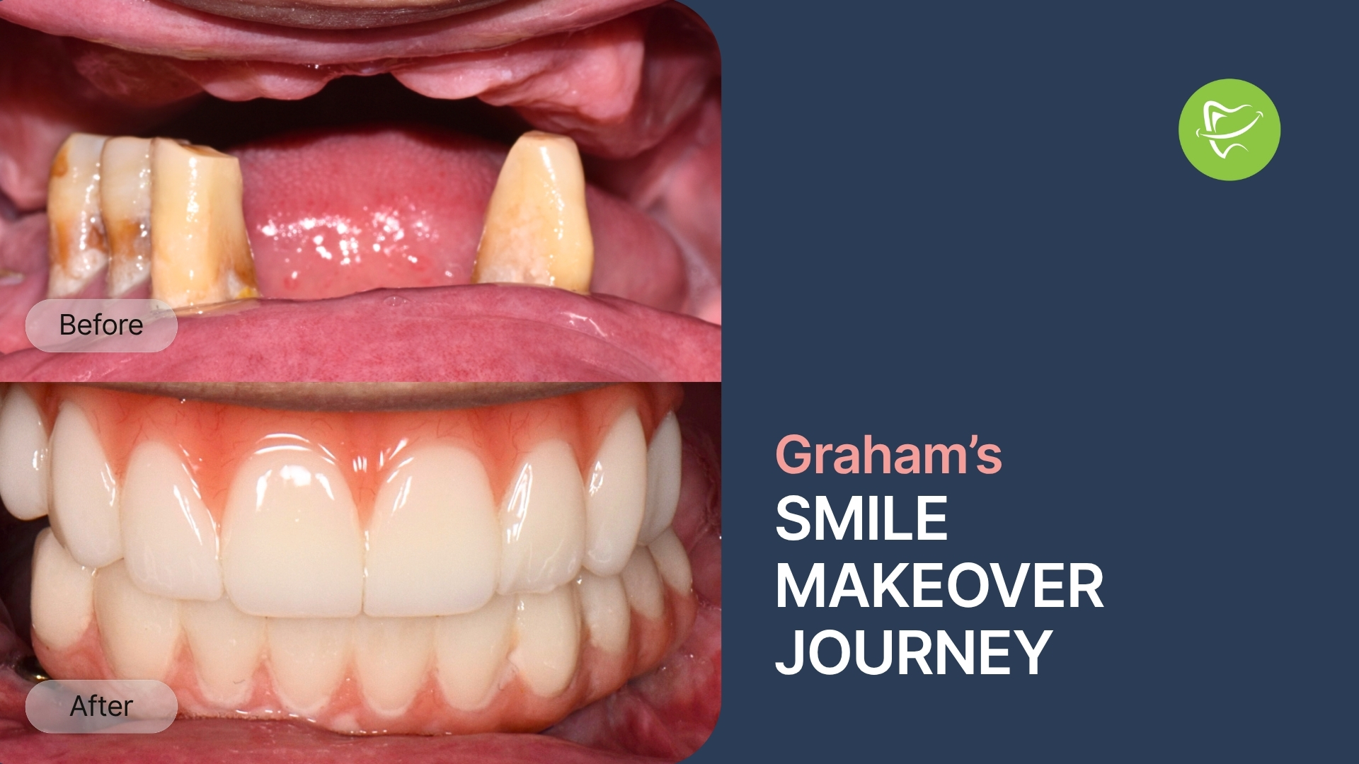 All-on-X Smile Restoration: How Graham from Glen Waverley Rebuilt His Smile at Liberty Dental