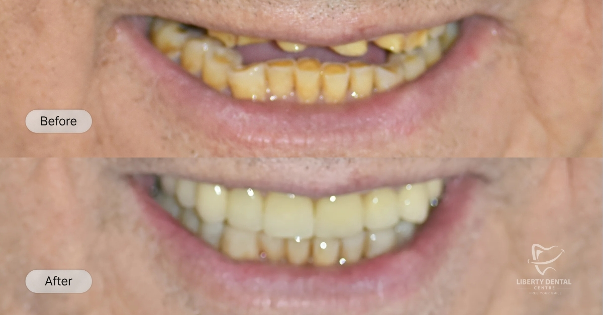 Gregg Of Rowville's Implants, Veneers, And Crowns Journey after 12-15 weeks