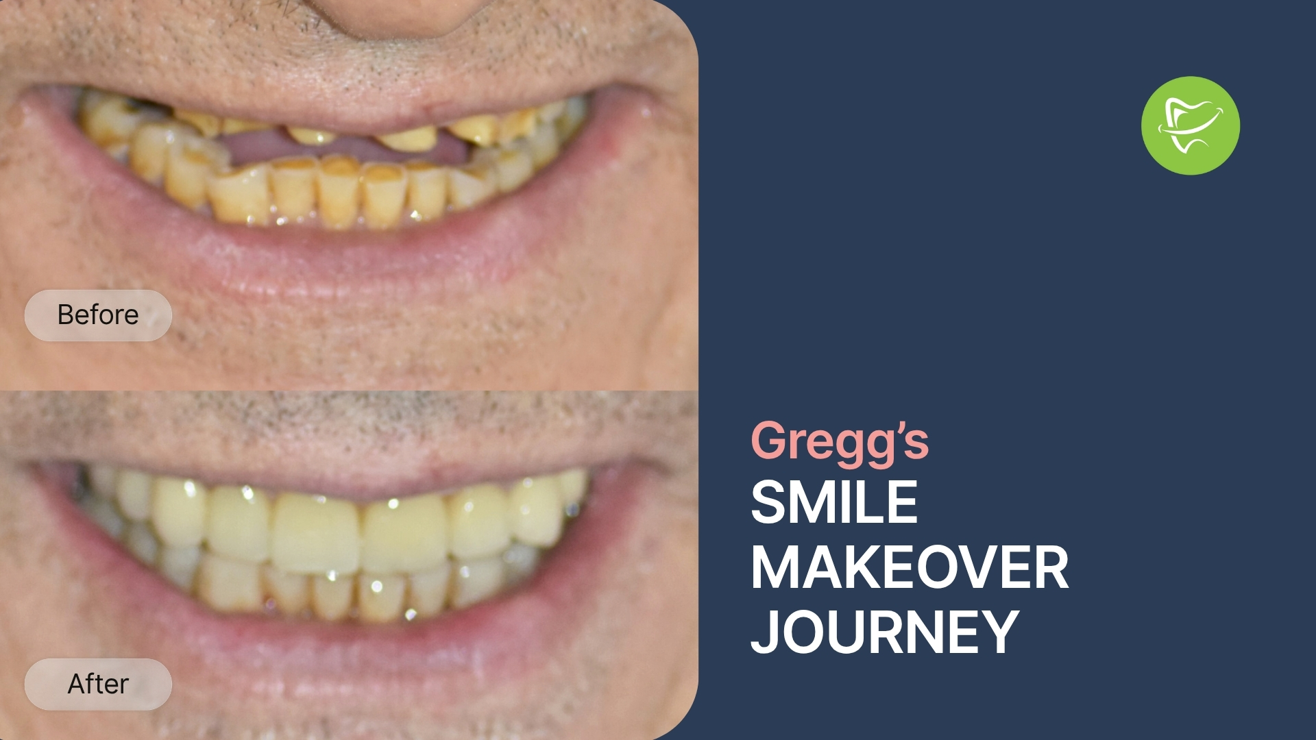 Smile Restoration Rowville: How Gregg Restored His Smile with Implants, Veneers, and Crowns at Liberty Dental