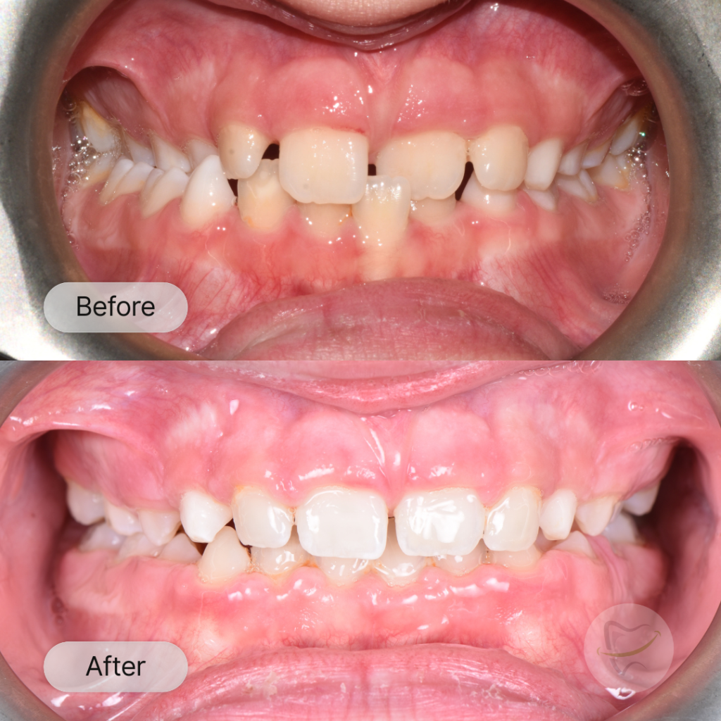 Harrison Braces In Liberty Dental after 8-12 months