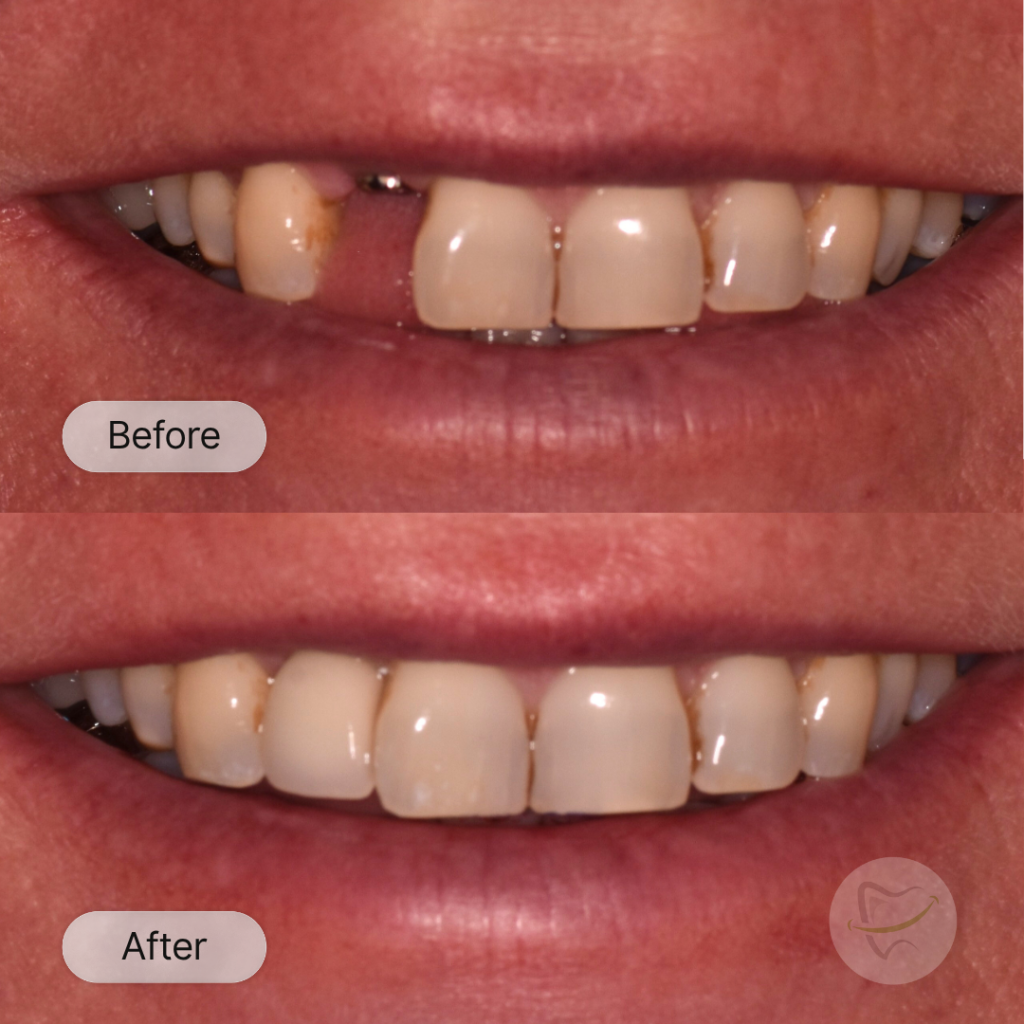 HB: Implant after 12 weeks