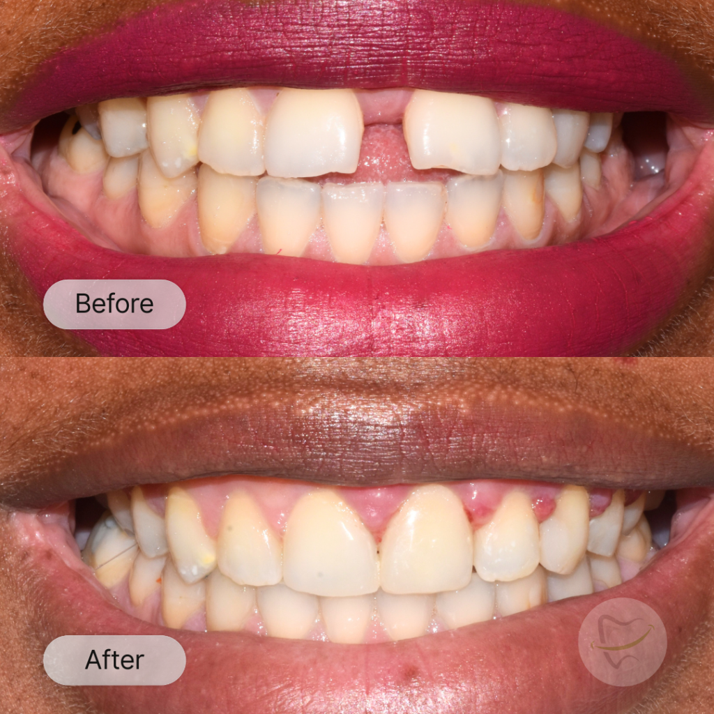 Ifi Braces In Liberty Dental after 8-12 months
