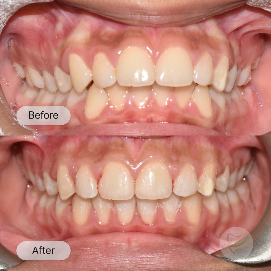 Ishika Braces In Liberty Dental after 8-12 months