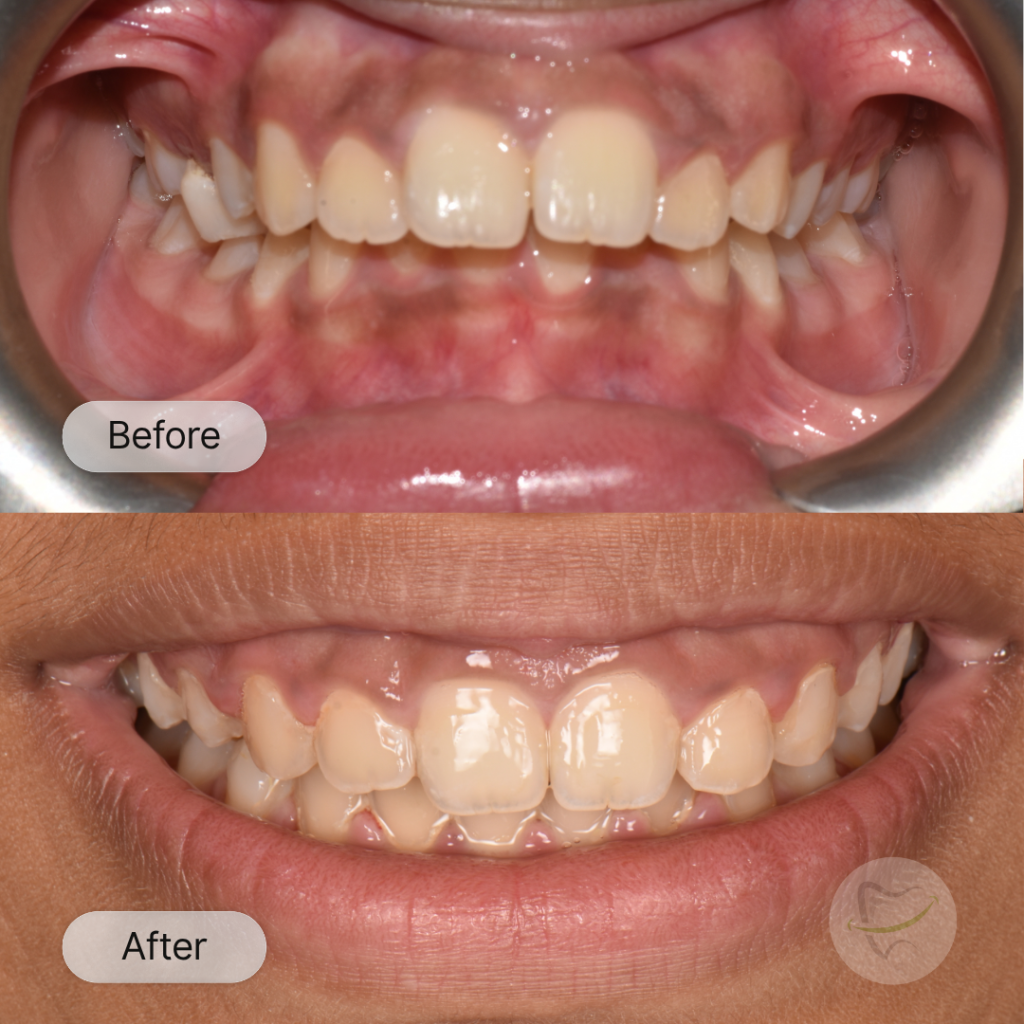 JJS Braces In Liberty Dental after 8-12 months