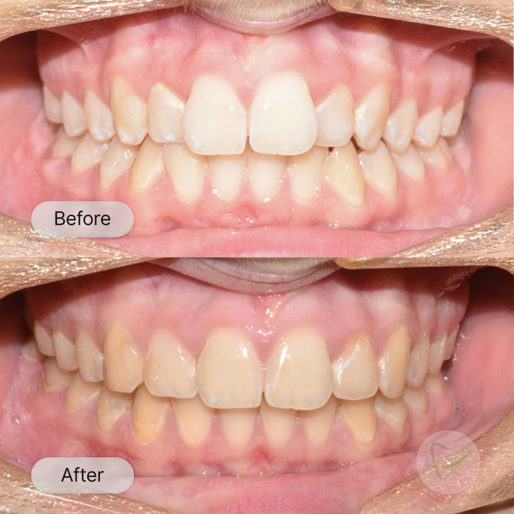 JLS Braces In Liberty Dental after 8-12 months