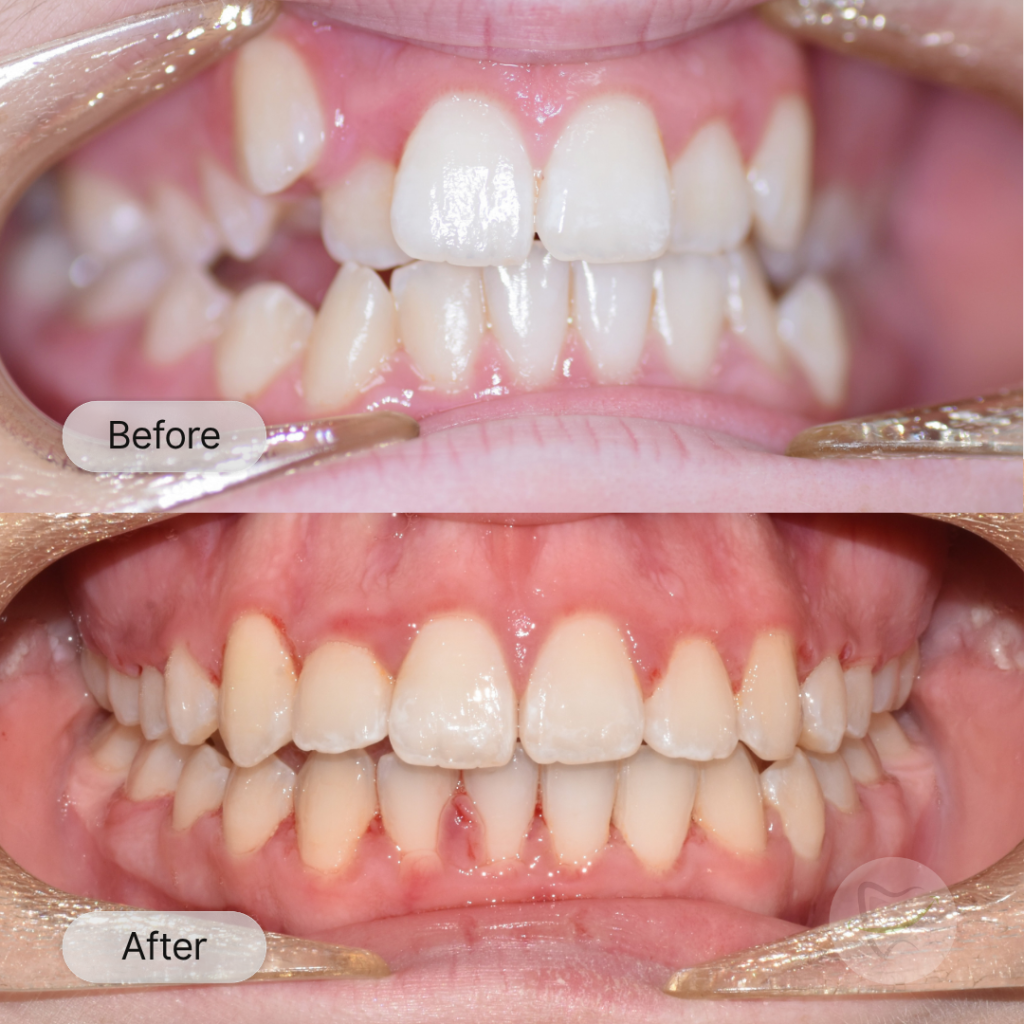 Jp's Braces In Liberty Dental after 8-12 months