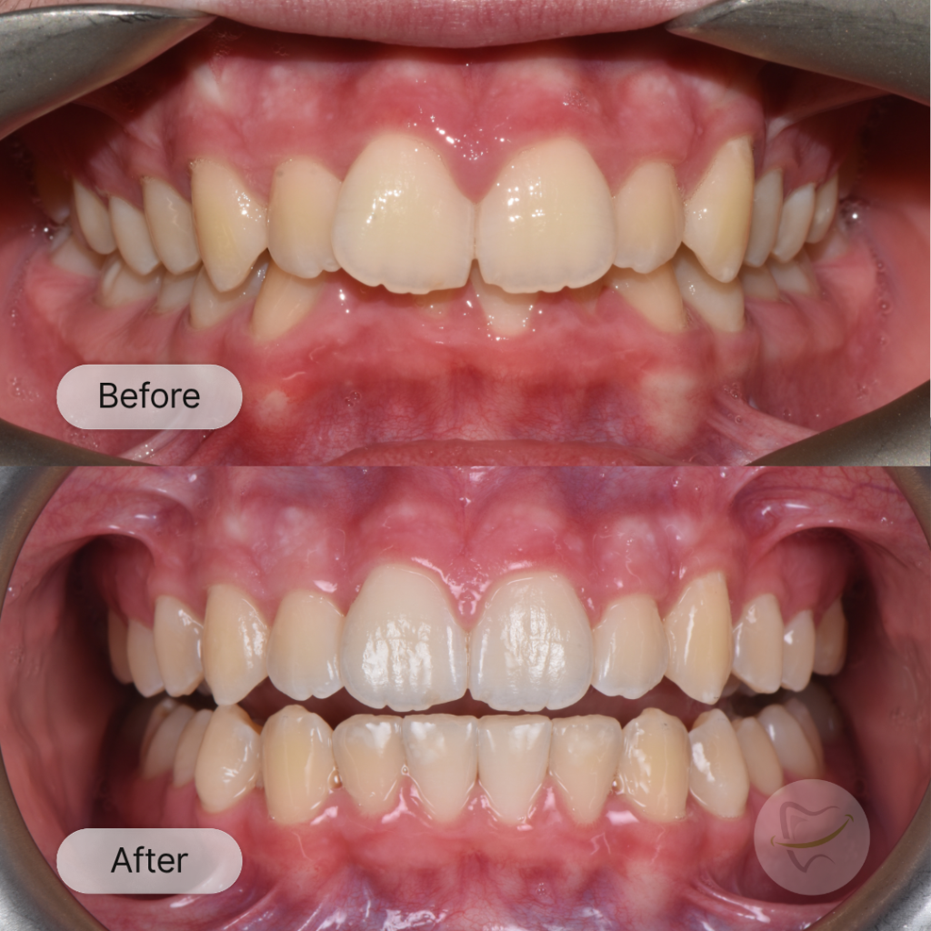 JD: Invisalign, after 12 months