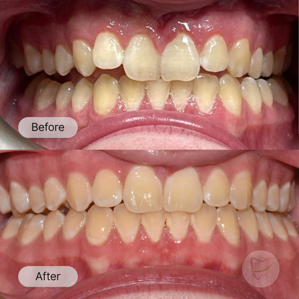 Jack: Invisalign, after 12 months