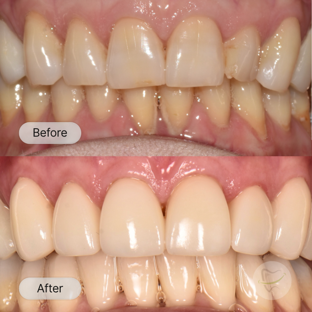 Jan GS Veneers In Liberty Dental after 2 weeks