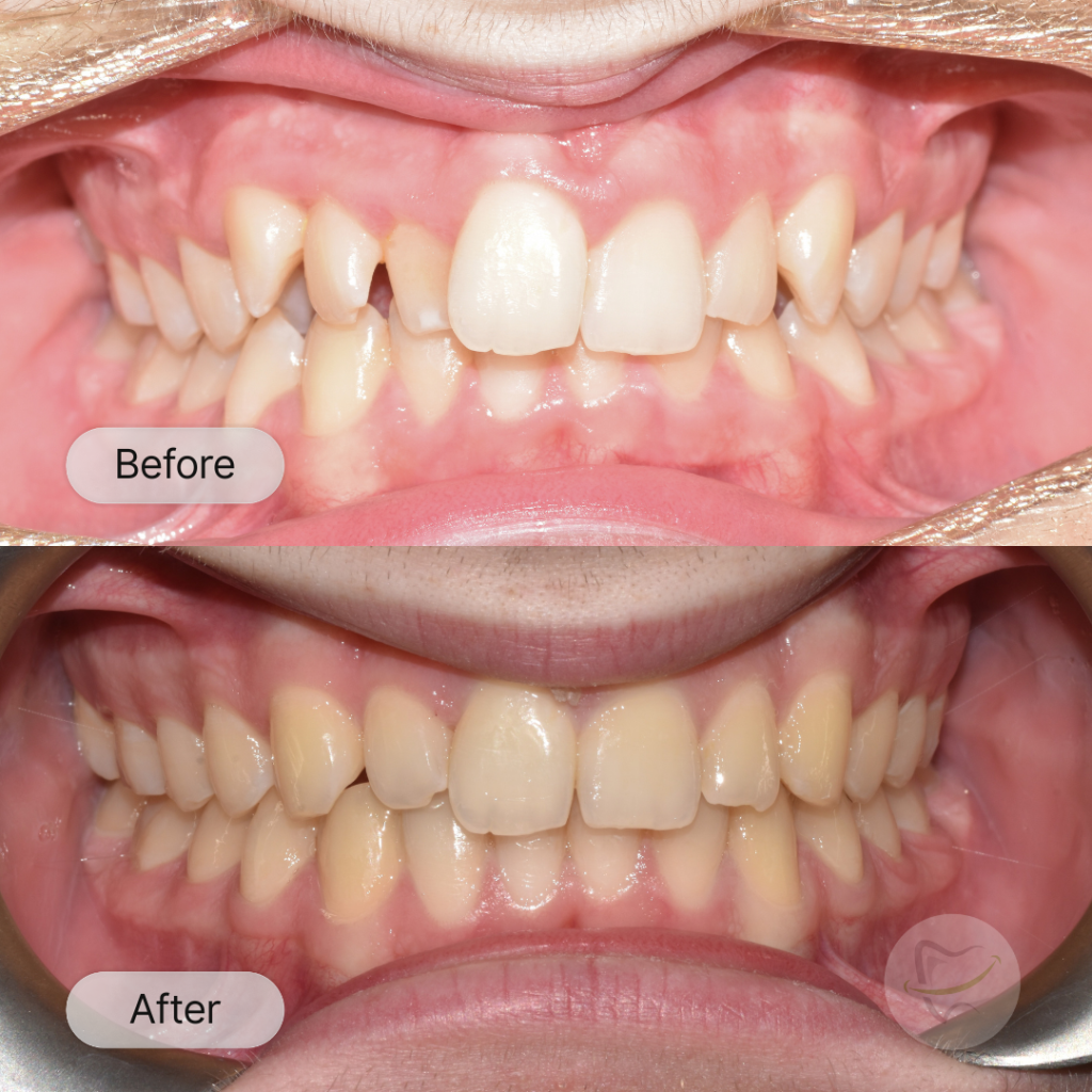 Jaylen Braces In Liberty Dental after 8-12 months