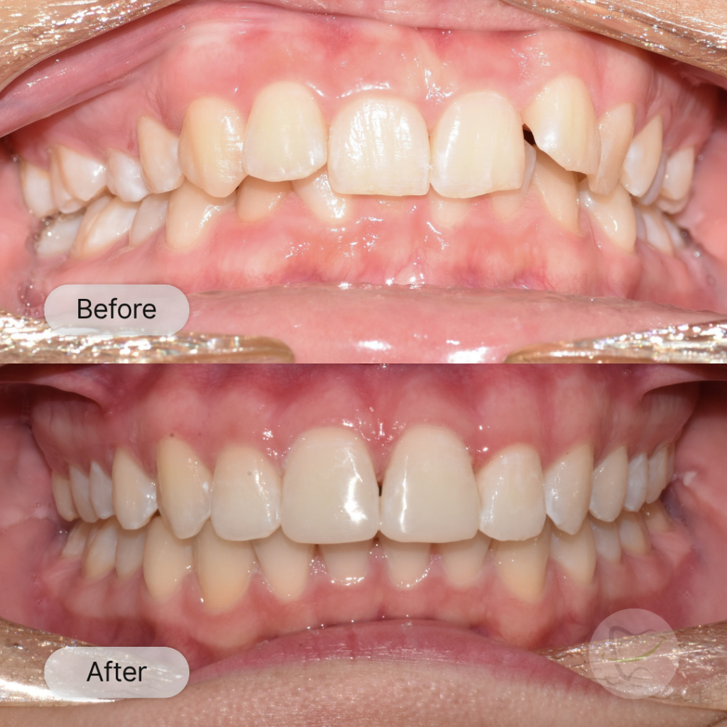 Jazz Braces In Liberty Dental after 8-12 months