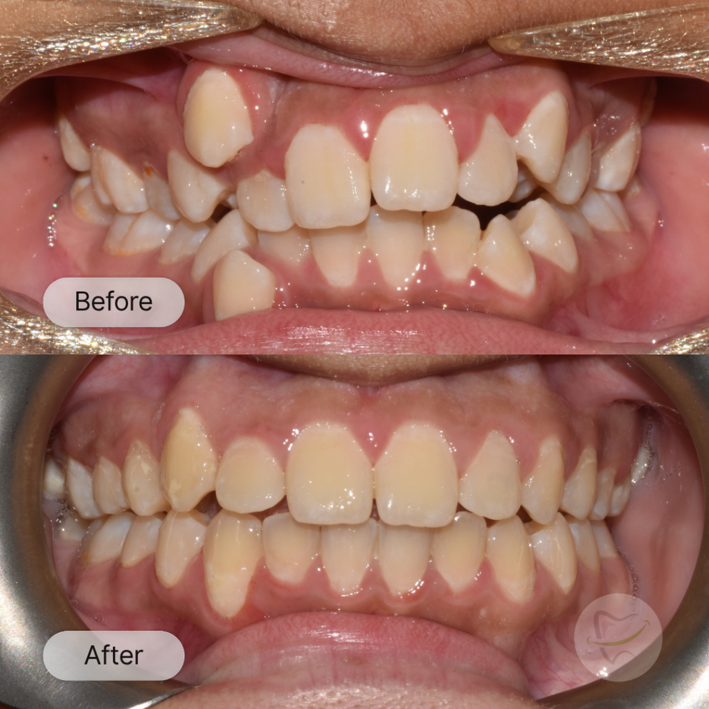 Jesrien Braces In Liberty Dental after 8-12 months