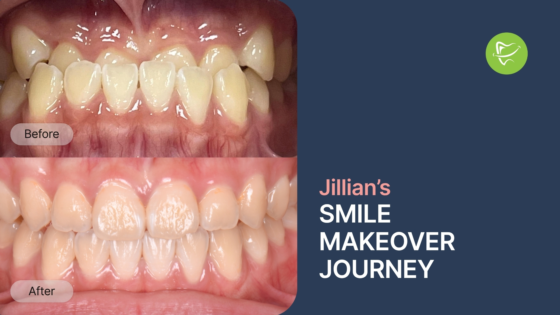 Invisalign Smile Transformation: How Jillian from Chadstone Fixed Her Reverse Overjet at Liberty Dental