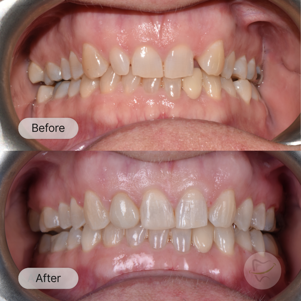 JP: Invisalign, after 16 months
