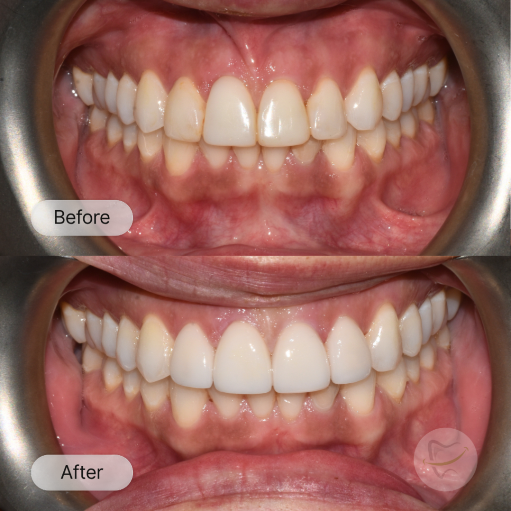 Josie-Ms-Ceramic-Veneers-In-Liberty-Dental