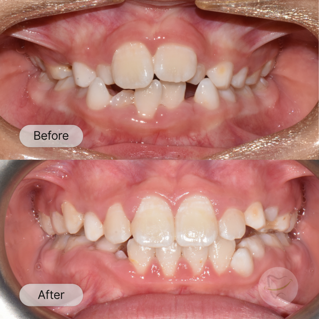 Kos Braces In Liberty Dental after 8-12 months