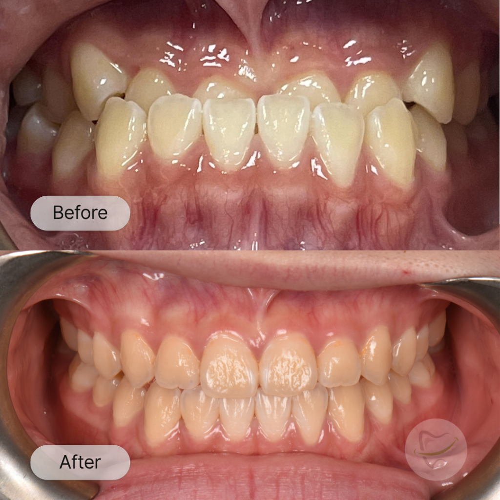 K: Invisalign, after 19 months