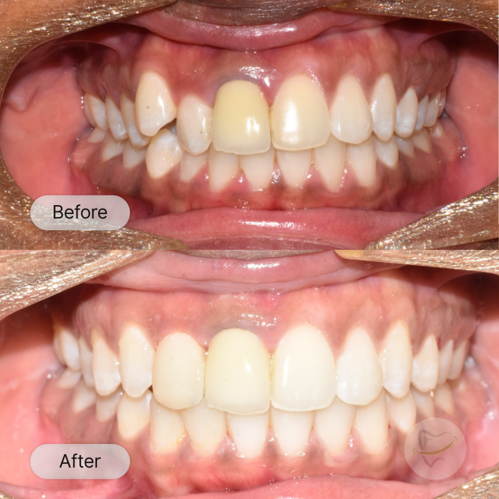 LA: Invisalign: after 8 months
