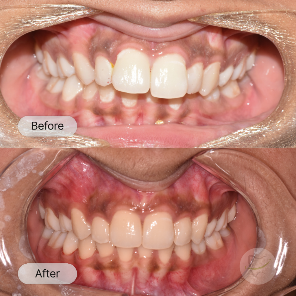 LB: Invisalign, after 17 months